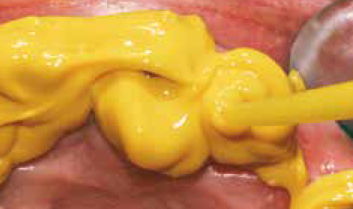 Нанесение Хонигум Лайт - этап 2